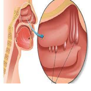 Viêm xoang polyp mũi có nguy hiểm không